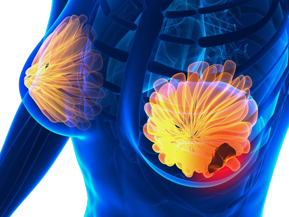 स्तन कैंसर के लक्षण ,निदान और उपचार